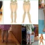 Х - образные ноги у ребенка: что это такое, симптомы деформации, гимнастика и массаж в борьбе с болезнью, консервативные методы терапии