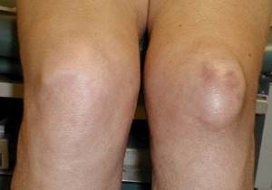 Дегенеративные изменения мениска коленного сустава: особенности патологии, как остановить, диагностика и лечение заболевания