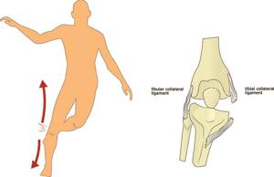 Разрыв связок коленного сустава: когда нужна операция, виды и степени травм, консервативная и оперативная терапия, реабилитация и сроки восстановления в домашних условиях