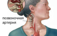 Цервикокраниалгия на фоне шейного остеохондроза: лечение и профилактика осложнения, виды и симптоматика заболевания, диагностические мероприятия