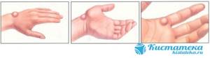 Киста на руке: признаки и особенности патологии, виды образований и диагностические мероприятия, методы терапии и показания для удаления