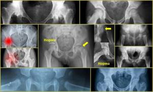 Рентген тазобедренного сустава: в каких случаях назначается, противопоказания и показания к исследованию, подготовка и проведение, расшифровка результатов и альтернативные диагностические методики