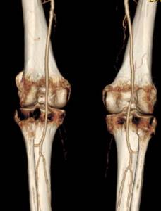 КТ коленного сустава: что показывает и как делается, чем отличается от МРТ, как правильно подготовится, когда назначается, что показывает