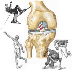 Разрыв крестообразной связки колена: основные признаки и причины травмы, стандартные этапы реабилитации и лечения, сроки восстановления