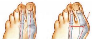 Применение медицинской желчи при косточках на ногах: целебные свойства, инструкция по использованию и противопоказания, правила лечения
