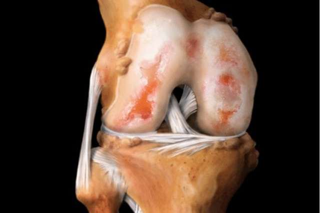 Лечение артрита коленного сустава народными средствами: простые и эффективные рецепты компрессов, ванночек и мазей, польза трав и прием внутрь, противопоказания
