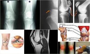 Лигаментоз коленного сустава: признаки и причины развития болезни, диагностические методики для определения патологии и способы терапии