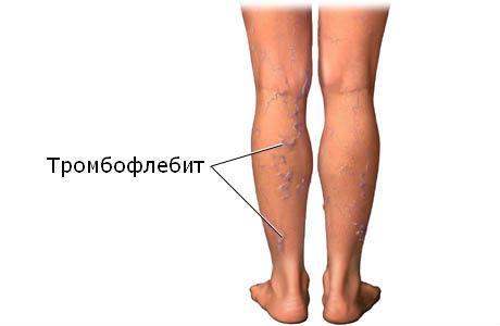 Почему немеют икры ног: физиологические и патологические причины онемения, клиническая картина и сопутствующие симптомы, лечение препаратами и народными средствами