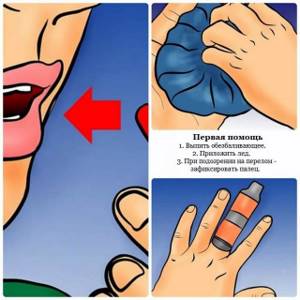 Ушиб пальца на руке: причины и симптомы, виды и степени травмы, первая помощь, способы лечения аптечными препаратами и средствами нетрадиционной медицины в домашних условиях