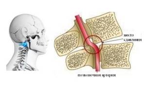 Тремор головы при шейном остеохондрозе: описание симптома и причины, разновидности и методы диагностики, лечебные методы и применяемые медикаменты
