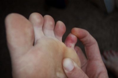 Перелом мизинца на ноге: классификация травмы, отличительные симптомы и методы диагностики, способы лечения и реабилитационный период, возможные осложнения
