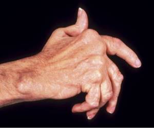 Ревматоидный артрит: причины и первые признаки заболевания, методы диагностики и лечения, осложнения и прогноз болезни