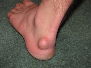 Гигрома на ноге: признаки и клиническая картина, как выглядит и почему появляется, способы терапии и показания к удалению, народные методы и последствия патологии