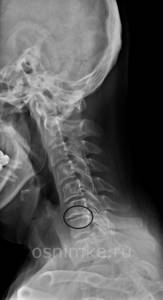 Рентген шейного отдела позвоночника: особенности диагностического метода, особенности подготовки к исследованию, что показывает снимок и кому противопоказана процедура