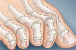 Невралгия ног: причины развития заболевания, классификация и характерные симптомы, способы диагностики и комплекс лечебных процедур, показания к операции и профилактика