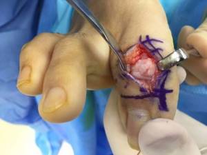 Перелом большого пальца на ноге: классификация повреждения, отличительные признаки и диагностика, лечение и реабилитационные мероприятия, сроки восстановления и осложнения