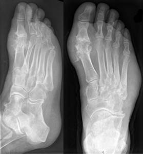 Косточка на ноге: механизм развития и клиническая картина патологии, стадии заболевания и способы терапии, медикаменты и физиотерапия