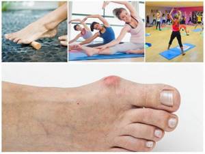 Воспаление косточки на большом пальце ноги: причины, симптомы, диагностика и лечение заболевания медикаментозными средствами, ортопедическими комплексами и мануальной терапией