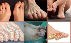 Искривление пальцев на ногах: ортопедические и медикаментозные методы устранения деформации, причины и признаки развития патологии, показания для операции