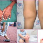 Ювенильный ревматоидный артрит у детей: описание и диагностика заболевания, разновидности и способы лечения болезни