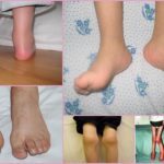 Ювенильный ревматоидный артрит у детей: описание и диагностика заболевания, разновидности и способы лечения болезни
