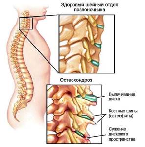 Почему возникает хондроз спины: основные причины, механизм развития, признаки заболевания, диагностические мероприятия и способы лечения