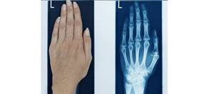 Рентген кисти руки: в каких случаях назначается, противопоказания, проведение процедуры, расшифровка результатов и альтернативные диагностические методы