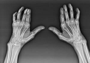 Артроз пальцев ног: причины патологии, механизм развития и симптомы, лечение аптечными и народными средствами, методы мануальной и физиотерапии, профилактика и прогноз