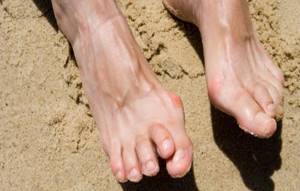 Артрит пальцев ног: причины и признаки болезни, разновидности и способы диагностики, медикаментозная и народная терапия, правила питания