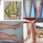 Посттравматический остеомиелит: клинические проявления и признаки заболевания, современные способы терапии и диагностические мероприятия, препараты и хирургическое вмешательство