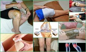 Какие компрессы при артрозе коленного сустава нужно делать: виды, преимущества использования народных методик, рецепты, отзывы пациентов