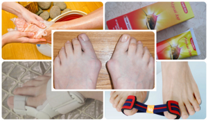 Лечение косточки на ноге у большого пальца без операции: причины нарушения, ортопедические, медикаментозные и народные средства для устранения патологии в домашних условиях