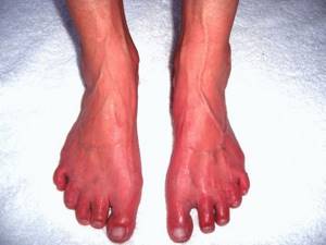 Боль в стопе между пяткой и носком: при каких заболеваниях появляется болевой эффект, лечение и профилактика, правильный выбор обуви и средств для устранения патологии
