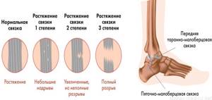 Растяжение связок на ноге: причины и признаки, симптомы, первая помощь, восстановление после повреждения, эффективные средства для лечения