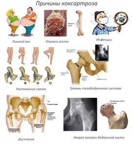 Диспластический коксартроз тазобедренного сустава: этиология и степени развития заболевания, методы диагностики, тактика лечения и меры профилактики