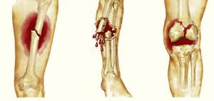 Перелом большеберцовой кости: основные причины и виды травмы, характерные симптомы и диагностика, первая помощь и методы лечения, реабилитационные мероприятия
