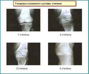 Двухсторонний гонартроз коленных суставов 2 степени: виды и развитие заболевания, симптомы и клиническая картина, особенности диагностики и лечения болезни