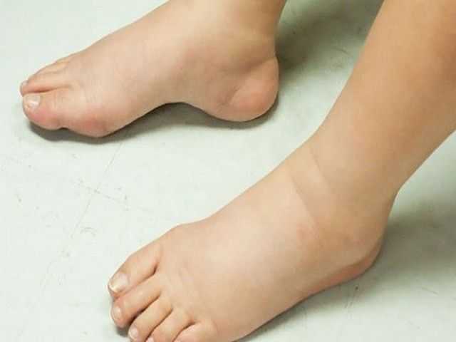 Ушиб пальца на ноге: степень и тяжесть, симптомы, первая помощь в домашних условиях и методы лечения