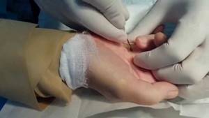 Щелкающий палец (стенозирующий лигаментит): признаки развития и клиническая картина, медикаментозная терапия и физиотерапия, стадии болезни