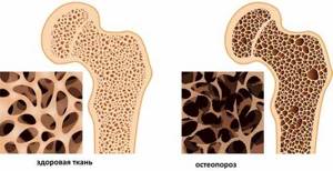 Остеопороз отделов позвоночника: признаки и причины заболевания, этапы развития и диагностика, лечебные методы и способы