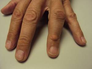 Шишка на большом пальце руки: что это может быть, причины появления, как лечить медикаментозно и показания к удалению
