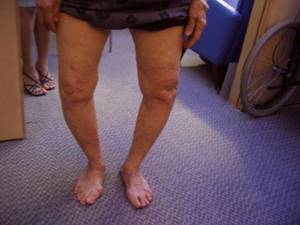 Варусная деформация коленных суставов: причины и симптомы заболевания, медикаментозные и народные методы лечения, способы профилактики и осложнения