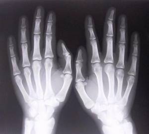 Рентген руки: эффективные методы исследования для постановки диагноза, что показывает и как проходит обследование, кому противопоказана диагностика