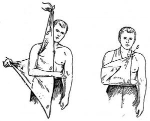 Эндопротезирование плечевого сустава: показания и противопоказания для проведения операции, типы протезов и этапы замены, процесс реабилитации