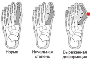К какому врачу обратиться с косточкой на большом пальце ноги: проявление заболевания и риски осложнений, способы диагностики и лечения оперативным, медикаментозным и физиотерапевтическим методом