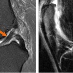 Разрыв крестообразной связки колена: основные признаки и причины травмы, стандартные этапы реабилитации и лечения, сроки восстановления