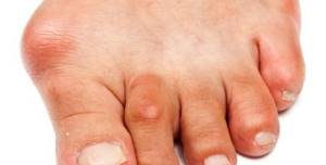 Болит большой палец на ноге: какие заболевания могут спровоцировать боль, способы лечения и снятия воспаления, к какому врачу обратиться для диагностики патологии