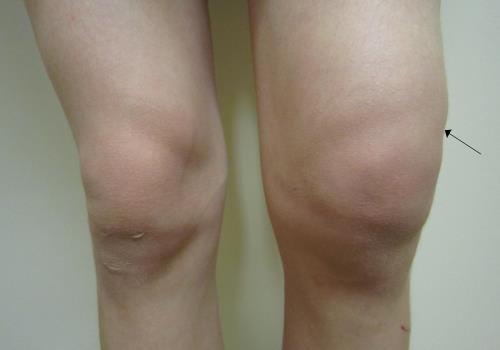 Болит колено когда сидишь: возможные заболевания и рекомендованные методы терапии, профилактические меры и когда идти к врачу