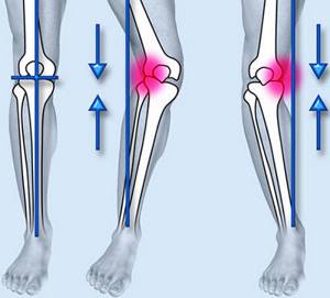 Разрыв связок коленного сустава: когда нужна операция, виды и степени травм, консервативная и оперативная терапия, реабилитация и сроки восстановления в домашних условиях