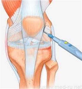 Растяжение связок коленного сустава: как проявляется, симптомы, первая помощь, разрешенные упражнения, диагностика и лечение